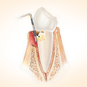 Fortgeschrittene Entzündung (Parodontitis)